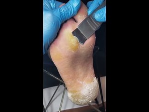 Soothing Foot Care: Gentle Corn Removal Process‪@LotusWellness-Pedicure‬