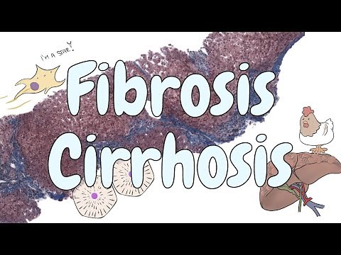 Fibrosis and cirrhosis - liver pathology