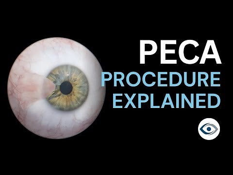 Pterygium Excision with Conjunctival Autograft (PECA) Procedure Explained | Precision Cornea Centre