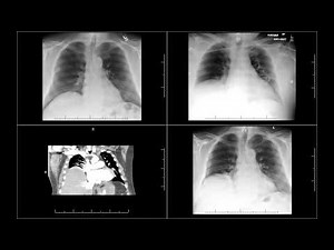 Chest tube probably injured phrenic nerve and cause right diaphramatic paralysi