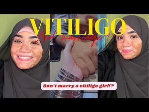 Vitiligo marriage | A problem? | How vitiligo effects my marriage..🙂 #vitiligo #education