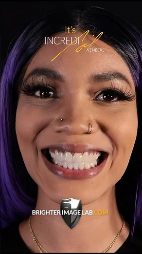 This Isn’t Magic, It’s Snap-On Veneers (Before & After)