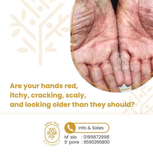 Did you know? Australian Pure Emu Oil naturally contains Omega 3, 6, and 9, along with Vitamins A, D, E, F, and K2. Packed with these nutrients, it's a safe and effective oil for nourishing, protecting, and healing troubled hands. Watch this simple remedy from Dr. Eric Berg to nourish dry, scaly, and cracked hands using three common kitchen ingredients. Watch the video here: https://youtu.be/pIB3neebwSk If you're short on time, jump to the 8-minute mark for the tip! To stay updated on our deals,