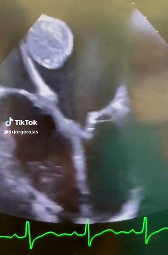 Fetus Ultrasound Images Explained