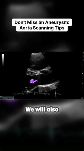 🚨 The Aorta Scanning Mistake That Can Miss an Aneurysm