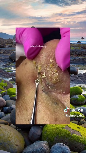 Big pimple satisfying #satisfying #satisfyingvideo #satisfy #cleantok #cleaning #explore #removal #skincare #fyp