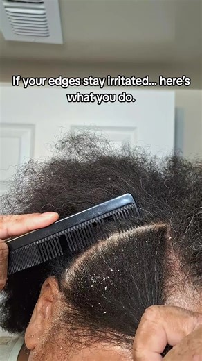 Understanding Seborrheic Dermatitis and Its Care