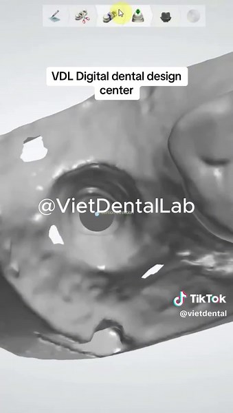 Implant Abutment digital dental design on 3shape #3shape #digitaldental #digitaldentaldesgin #abutment #implants