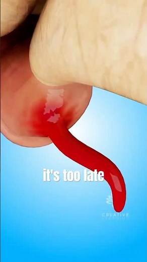 Inside a Burst Appendix Surgery 😱 #appendectomy