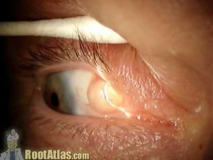 Ophthalmology finding: Inclusion cyst on the eye