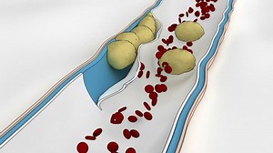 Coronary Embolus Travels Through Circulatory System Stock Footage Video (100% Royalty-free) 2668949 | Shutterstock