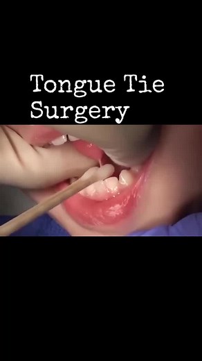 Tongue tie surgery involves cutting the band of tissue beneath the tongue to improve speech, feeding, and oral development.