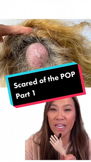 TENSE Cyst Extraction | Dr. Pimple Popper Part 1