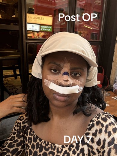 Nose Cast Removal Experience After Rhinoplasty