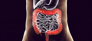 Colectomia: o que é, como é feita e indicações