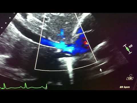 IVC 2d echo with color flow doppler of the inferior vena cava w/collapse