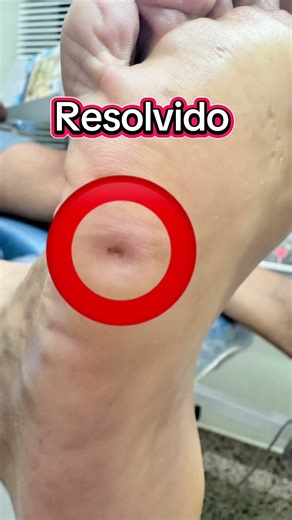 Heloma or plantar callus? #care #lasertherapy #mycosis #podology #nail