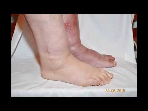 LINFANGITIS LINFEDEMA ELEFANTIASIS CAUSAS SÍNTOMAS Y TRATAMIENTO