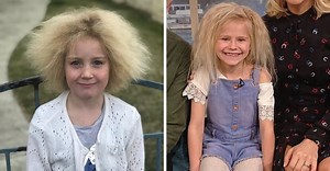 'Uncombable Hair Syndrome' Is A Real Genetic Condition
