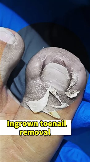 Ingrown toenail removal #ingrowntoenail #toenailremoval #viralvideo #ingrowntoenailremoval #toenails #pedicure #foryou #fyp