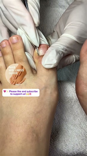 ✨ Swollen Toenail Relief: Simple Care Tips for a Pain-Free Day! 🌿🦶💗 #nails