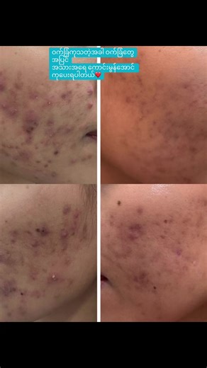 Nodular Cystic Acne Treatment & Skin Barrier Repair