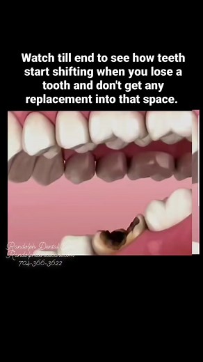 Preventing Complications: Replacing Missing Teeth for Oral Health