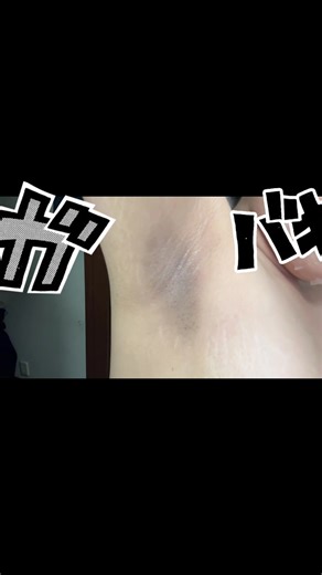 やばくないですか？私の脇 小5からずっとこれです。 私と同じ悩みの人いませんか、、 昔掻きむしってから赤く腫れての繰り返しで痒くてかきまくってたら真っ黒に黒ずんできてそこから治る気配ゼロでもうこの脇と6年以上付き合ってます 太っている原因もあると思います。 どうしたらいいですか、脇の黒ずみレベルMAXです 治したいです夏にノースリーブなんか一生着れないです 助けてください😭😭😭治したいです #脇の黒ずみ#色素沈着 #脇の黒ずみ治し方 #コンプレックス#おすすめ乗りたい