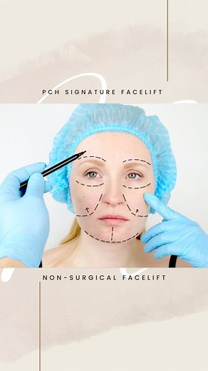 PCH Signature Face Lift: Facetite Or Agnes RF Facial Contouring Morpheus8 Skin Tightening x 3 sessions Halo Laser 1-2 sessions PDO Thread Full Lift Red Light Rx 4 sessions Alastin Regenerative Complex Exosome Rx Length of Rx: 8-10 weeks Guaranteed Results! #pchmedspa #skintighteningtreatment #faceliftnewportbeach #morpheus8newportbeach #pdothreads #pdothreadlift #pdonewportbeach #drkavehkarandish #drkmedspa #agnesrf #agnesrfmicroneedling #facetite | PCH MedSpa