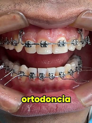 ¿Brackets por cuánto tiempo? Cada sonrisa tiene su propio tiempo de tratamiento. En este video, te explicamos cuánto puede durar tu ortodoncia y qué factores influyen. 🦷 📅 ¡Agenda tu evaluación en Quicentro Clínica Dental y comienza tu transformación hoy mismo! ✨ #Ortodoncia #Brackets #QuicentroDental #SonrisaPerfecta #saludbucal