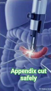 Appendix cut safely #health #anatomy #surgery #appendectomy #leproscopy #viral #appendix cut #
