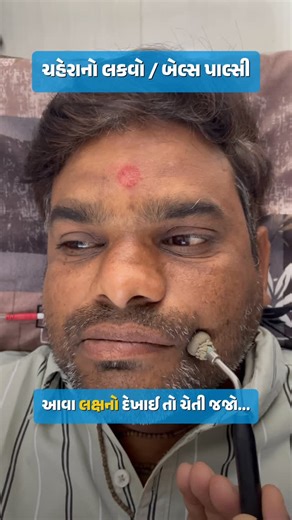 Recovery Physiotherapy Clinic on Instagram: "ચહેરાનો લકવો / Bell’s Palsy . . Facial Paralysis (Bell’s Palsy / Facial Nerve Paralysis) . . {Facial Paralysis (Bell’s Palsy / Facial Nerve Paralysis), Facial paralysis can affect people of any age, Bell’s palsy symptoms, Other conditions - Stroke, brain tumor, Lyme disease, or trauma, born with facial paralysis, dr piyush babariya, spine sports neuro rehabilitation, human movement specialist, physiotherapist} . #facialparalysis #bellspalsy #facialexe