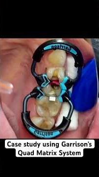 Using Garrison’s Quad Matrix System on a patient