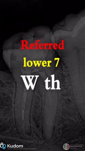 Dr. Khaled Khalifa on Instagram: "🤔𝐇𝐨𝐰 𝐓𝐨 𝐌𝐚𝐧𝐚𝐠𝐞 𝐋𝐞𝐝𝐠𝐞𝐬 & 𝐁𝐥𝐨𝐜𝐤𝐚𝐠𝐞𝐬?💡 In this case, we had a 𝗩𝗲𝗿𝘁𝘂𝗰𝗰𝗶 𝗧𝘆𝗽𝗲 𝗜𝗜 𝗰𝗮𝗻𝗮𝗹 𝗰𝗼𝗻𝗳𝗶𝗴𝘂𝗿𝗮𝘁𝗶𝗼𝗻 ➡️ two orifices joining into the same apex. When one canal was blocked, the debris also obstructed the other at the junction. The Previous Dr forced files created a 𝗹𝗲𝗱𝗴𝗲 at that level ( Junction ) — a very common scenario where the blockage can turn into a ledge due to improper managment❗️ ———————— 💡 �