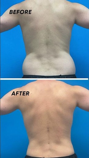 Men’s liposuction and Renuvion Before and After #boardcertifiedplasticsurgeon