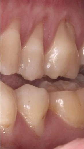 Can You Regrow Your Gums Naturally?