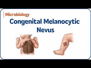 4. Congenital Melanocytic Nevus | USMLE Step 1 🧠✨