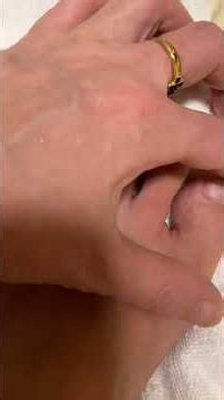 水虫治療激しい痒みや痛みにはティッシュをキュッと巻いて皮膚と筋膜を締めると効く。気持ちいいです。だから分かる。ティッシュがトイレットペーパー。首など濡らしたタオルシャワー後使ったタオルでも良い。