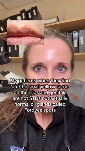 Dr. Abigail Waldman, MD FAAD on Instagram: "Fordyce spots are small, yellow-white bumps that appear on the genitals and lips. They are caused by enlarged sebaceous glands and are often confused with genital warts or other STDs. I once had a patient come to me in residency and wanted me to treat every single one on his scrotum since he was convinced they were an STD 😬 They are usually asymptomatic but can be itchy. They are benign, and don’t require treatment but can be treated with retinoids or