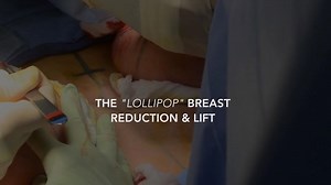 The "Lollipop" Breast Reduction & Lift with Dr. Norman Rowe (GRAPHIC)
