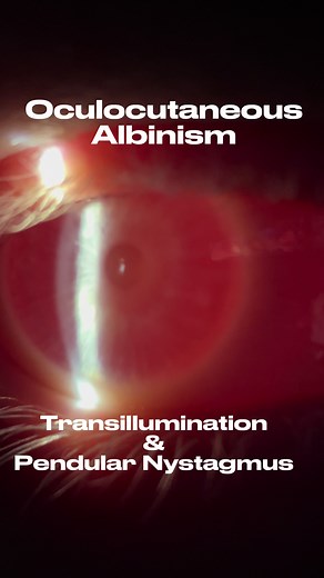 Oculocutaneous Albinism: Understanding the Condition