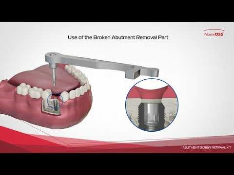 T6 Standard | Abutment Screw Retrival Kit