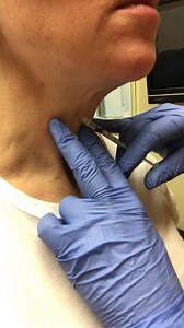 If neck area is sagging or causing a turkey neck appearance, or if you have shallow horizontal lines across your neck, Botox can smooth and tighten these areas to reveal a more youthful neck.