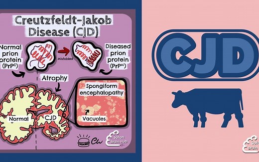 克-雅病（Creutzfeldt-Jakob disease, CJD）| 双语字幕