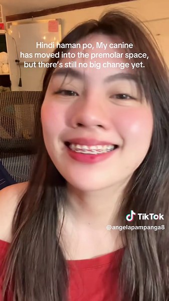 Understanding Premolar Extraction and Recovery Process