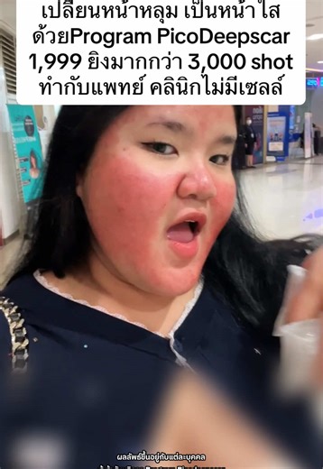 เปลี่ยนหน้าหลุมเป็นหน้าใสด้วย PicoDeepscar
