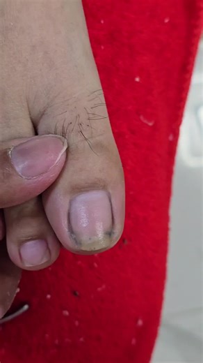 Manicure at Home: Ingrown Toenail Cleaning Tips