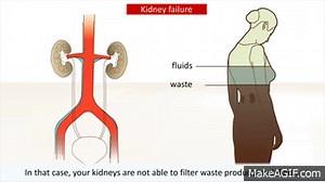 Kidney disease - Causes and treatment of kidney failure on Make a GIF