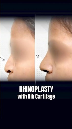 Rhinoplasty | Flat Nose Correction Before & After