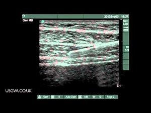 Ultrasound Guided TAP (Transversus Abdominis Plane) Block